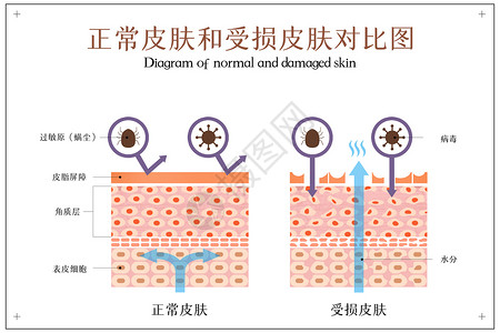 角质层薄正常皮肤和受损皮肤对比示意图插画