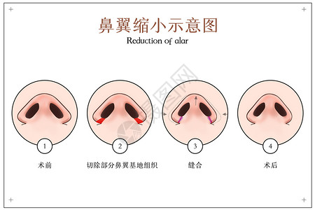 小小世界鼻翼缩小手术示意图插画