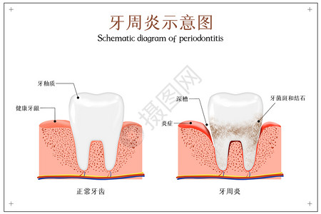 口腔美容牙周炎示意图插画