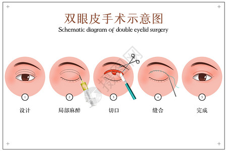 美容眼部双眼皮手术示意图插画