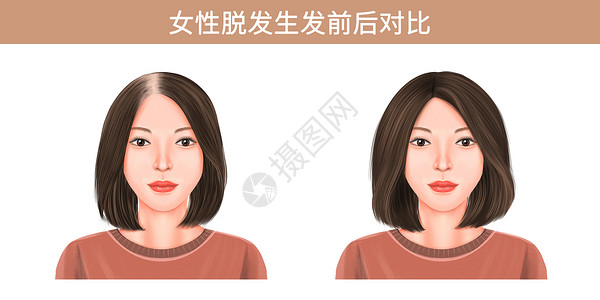 中年女性头疼女性脱发生发前后对比插画插画