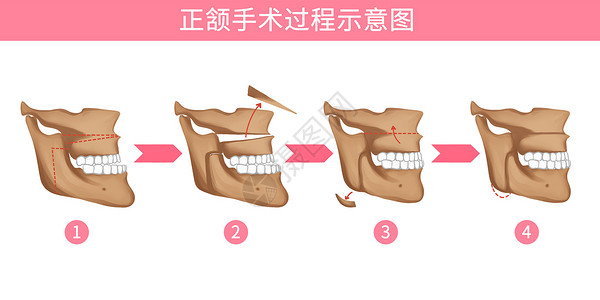 口腔正颌手术过程医疗插画图片