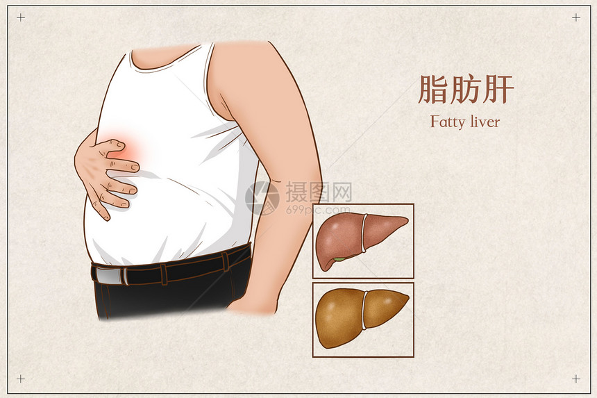 脂肪肝医疗插画图片
