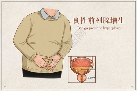 良性前列腺增生医疗插画高清图片