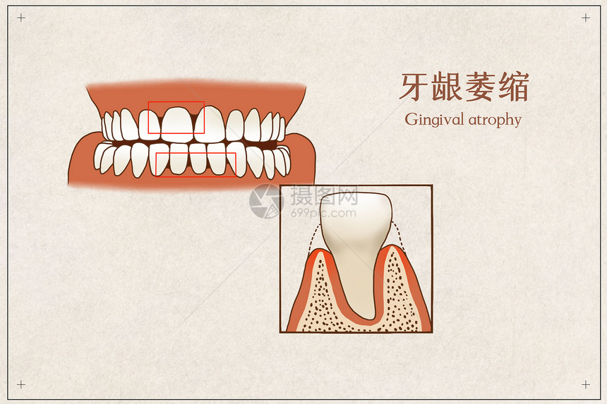 牙龈萎缩医疗插画图片