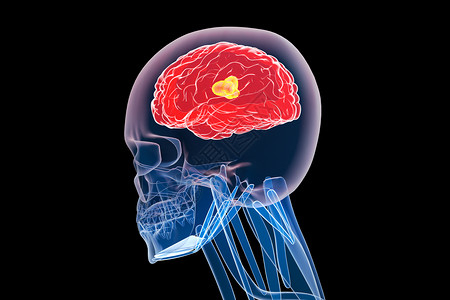 C4D脑部疾病背景图片