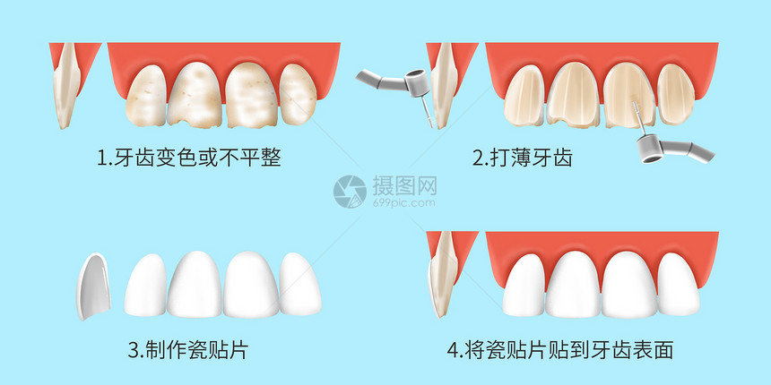 瓷贴面的治疗过程医疗插画图片