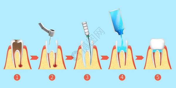 根室牙齿根管治疗步骤医疗插画插画