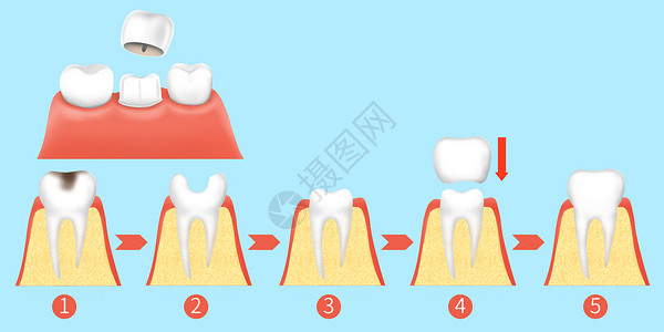 牙齿烤瓷牙治疗步骤医疗插画背景图片