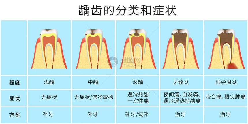 龋齿的分类和症状科普医疗插画图片