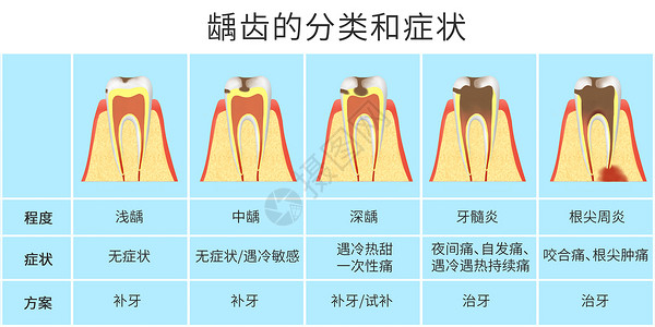 龋齿的分类和症状科普医疗插画图片素材