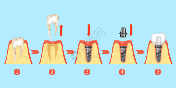 牙齿种植牙治疗过程步骤医疗插画图片