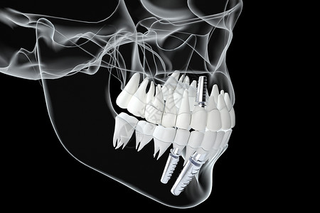 下颌骨医美牙齿修复场景设计图片