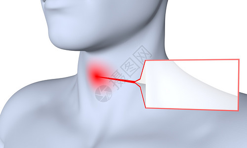 咽炎咽喉肿痛设计图片