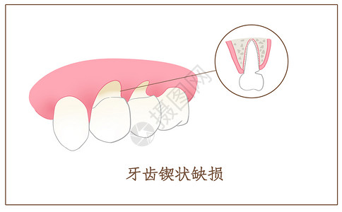 牙齿缺损牙齿锲状缺损口腔医学配图插画