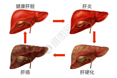 内脏乙肝肝脏病变症状医疗插画插画