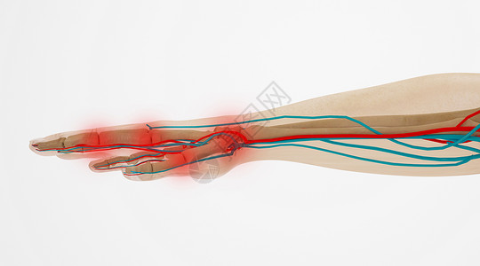 手腕特写C4D腱鞘炎场景设计图片