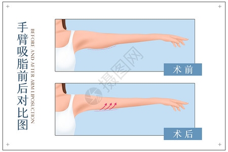 使用前后手臂吸脂前手术前后对比示意图插画