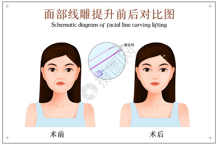 面部线雕提拉手术前后对比示意图插画