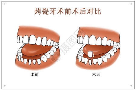 术前准备烤瓷牙术前术后对比口腔医学配图插画