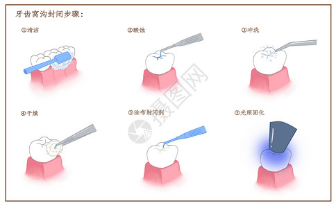 口腔护理工具牙齿窝沟封闭步骤插画