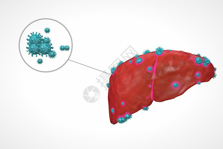 乙肝病变设计图片