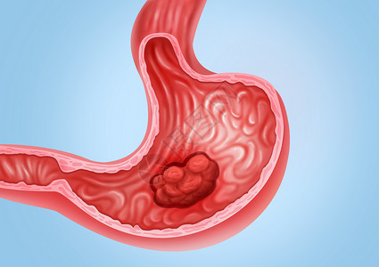 结果胃癌医疗健康插图插画