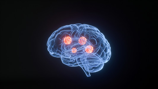 脑瘤3D疾病脑癌场景设计图片