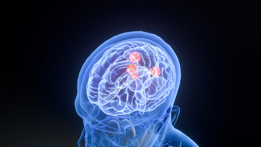 脑瘤3D疾病脑癌场景设计图片