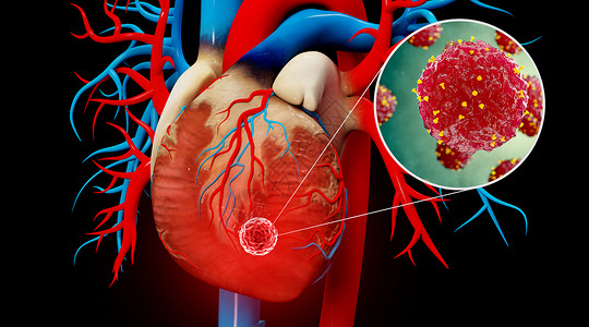 人体心脏疾病场景图片