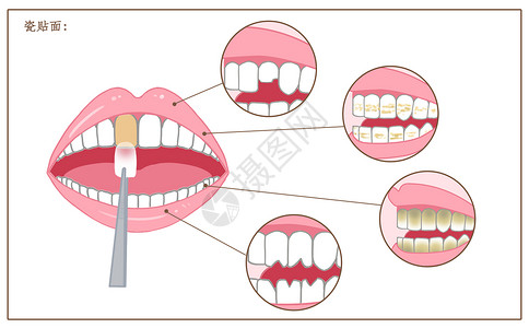 牙齿缺损牙齿瓷贴面修复口腔医学配图插画