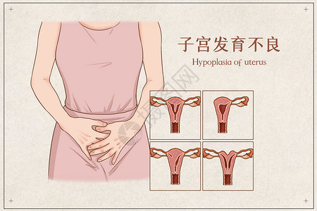 子宫发育不良医疗插画图片