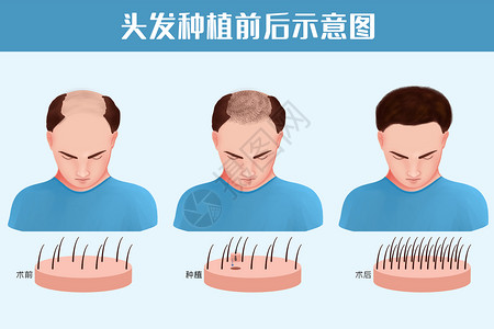 头发种植前后对比图插画