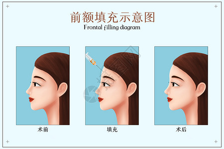 额头前额扁塌填充手术医疗配图插画