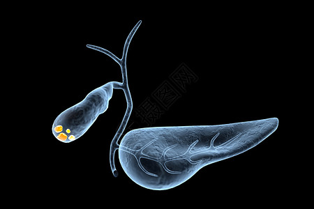 胆囊结石疼痛胆结石高清图片
