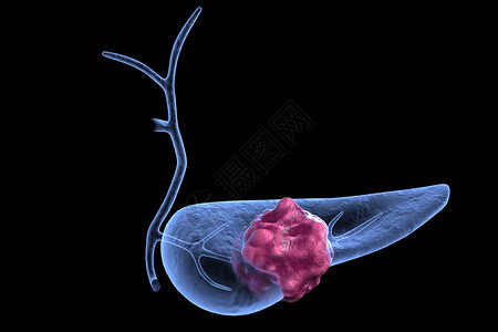 胰腺肿瘤模型高清图片