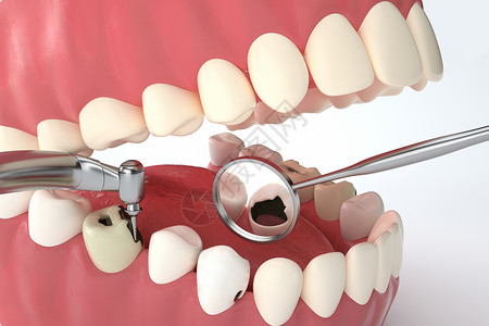 牙疼龋齿修补设计图片