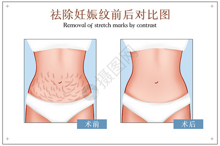 肌肤检测妊娠纹祛除手术前后对比图插画