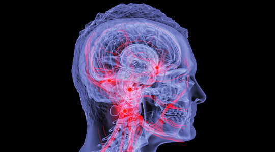 脑健康人体脑动脉瘤场景设计图片
