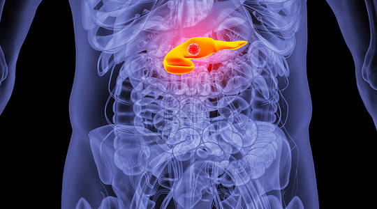 人体胰腺癌场景人体模型高清图片素材