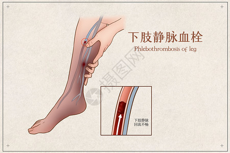 下肢静脉血栓医疗插画高清图片