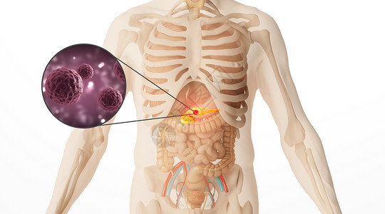 人体胰腺癌场景图片