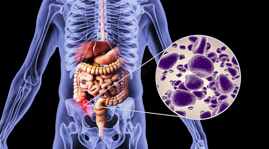 人体阑尾炎场景高清图片