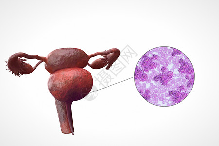阴道炎症阴道细菌感染设计图片