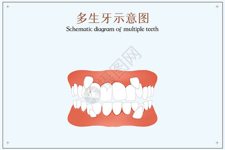 牙齿不齐多生牙示意图口腔医学插图插画