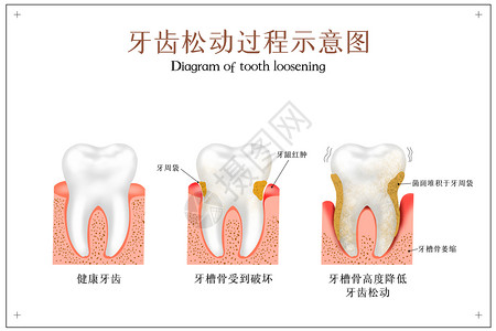 口腔护理三折页牙齿松动过程牙科配图插画