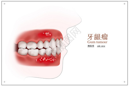 牙龈瘤口腔医学配图背景图片
