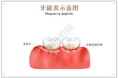 肌肤红肿牙龈炎口腔医学配图插画