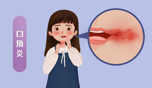 医疗营养口角炎口腔医学插图插画