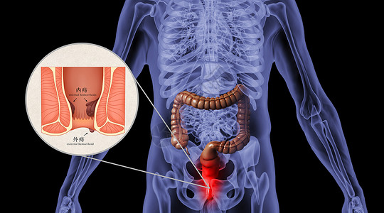 结肠息肉人体痔疮场景设计图片